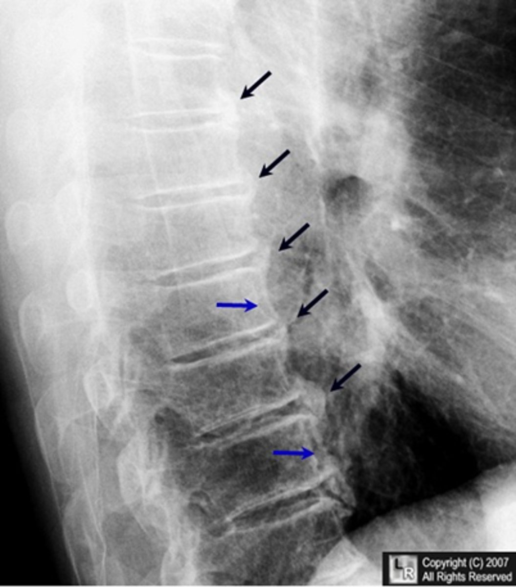 <p>DISH = ossification of the longitudinal ligaments of the spine that produce syndesmophytes</p>